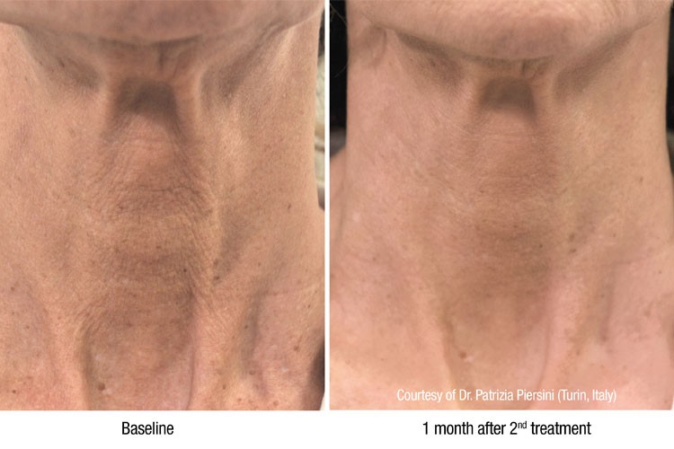 Paragon Aesthetics Treatments Profhilo Image