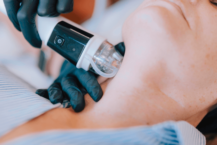 Radiofrequency Microneedling Image Full