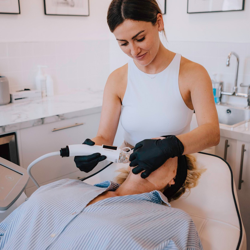 RF micro needling Newcastle