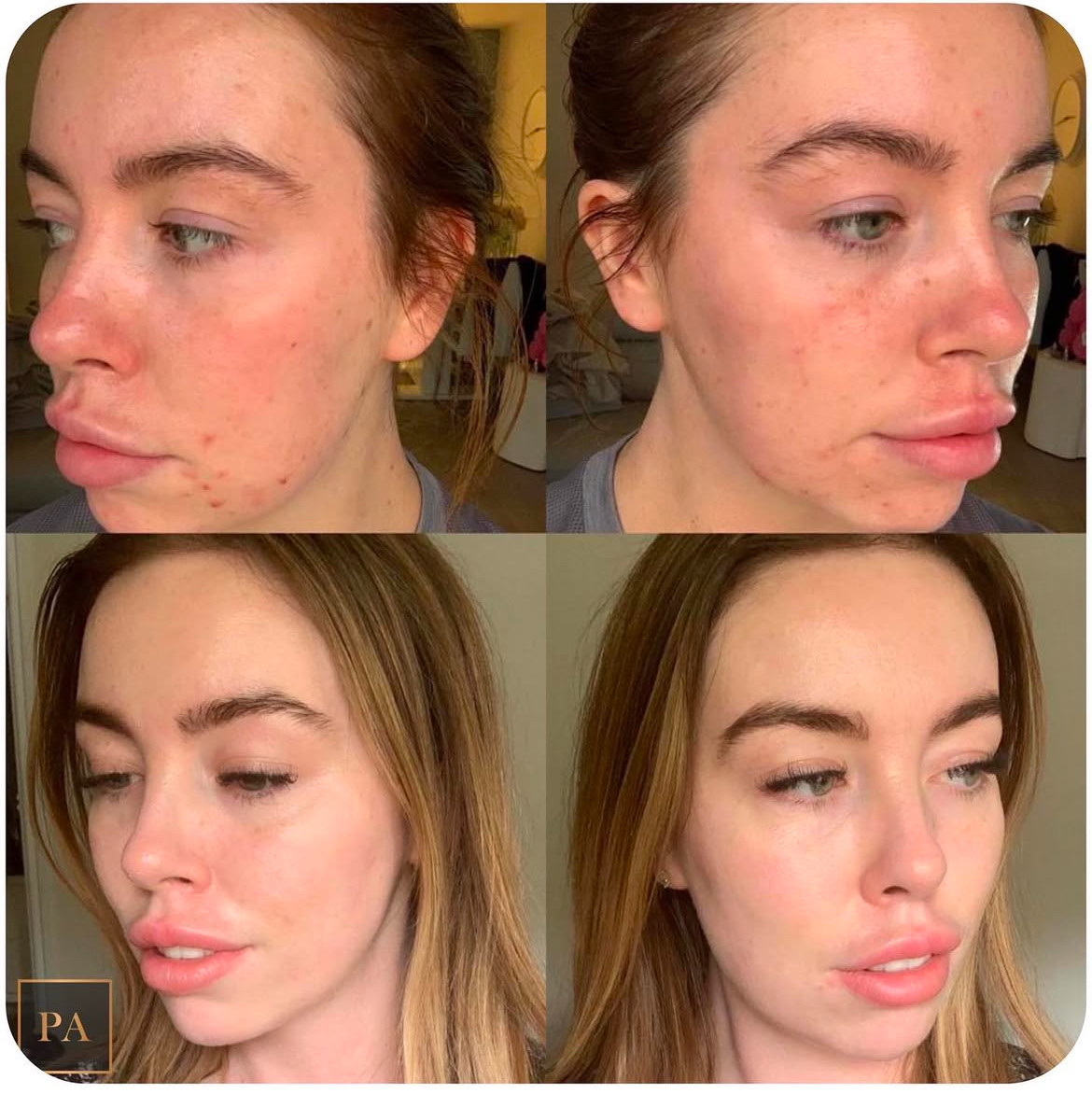 Acne treatment Newcastle
