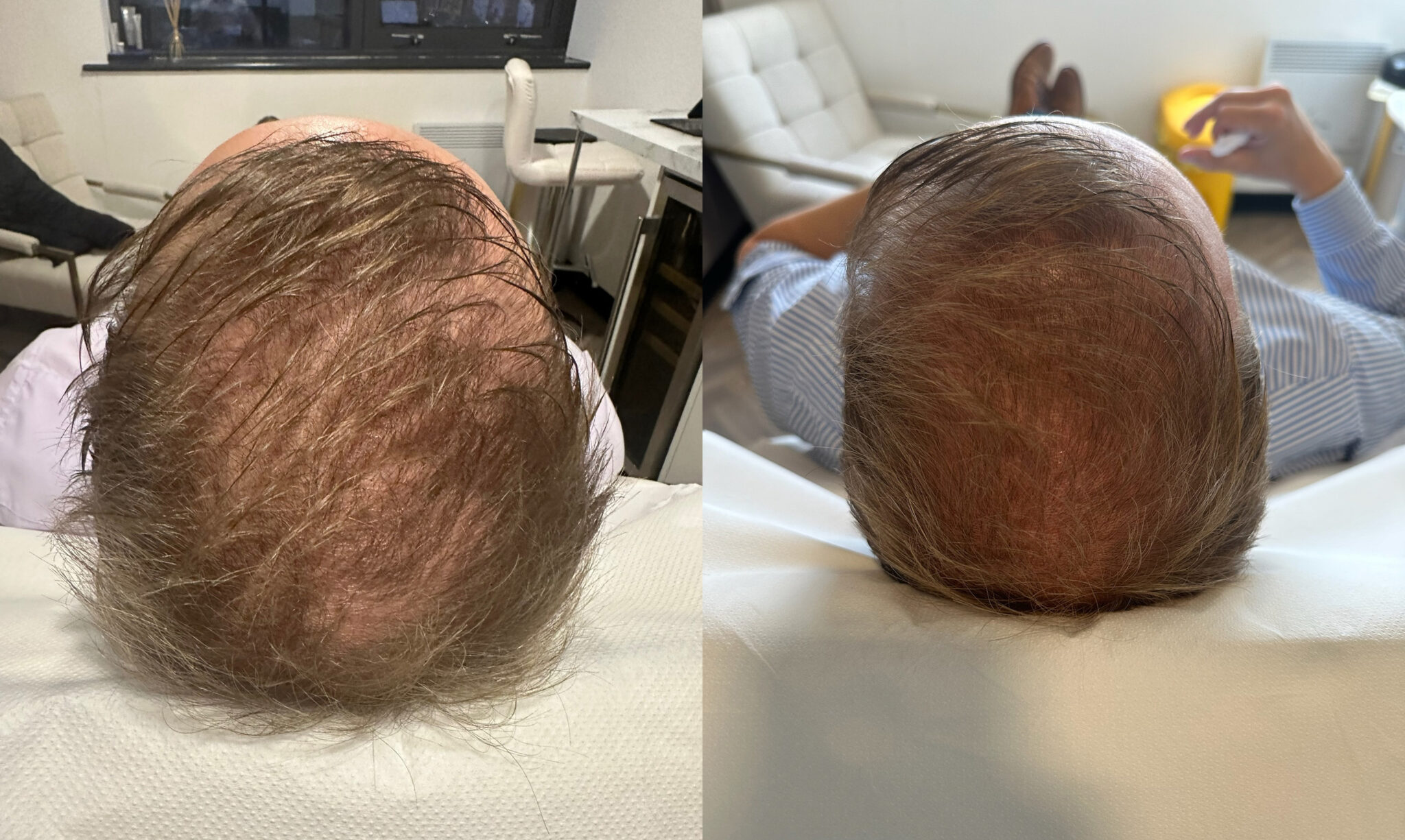Hair replacement clinic Newcastle