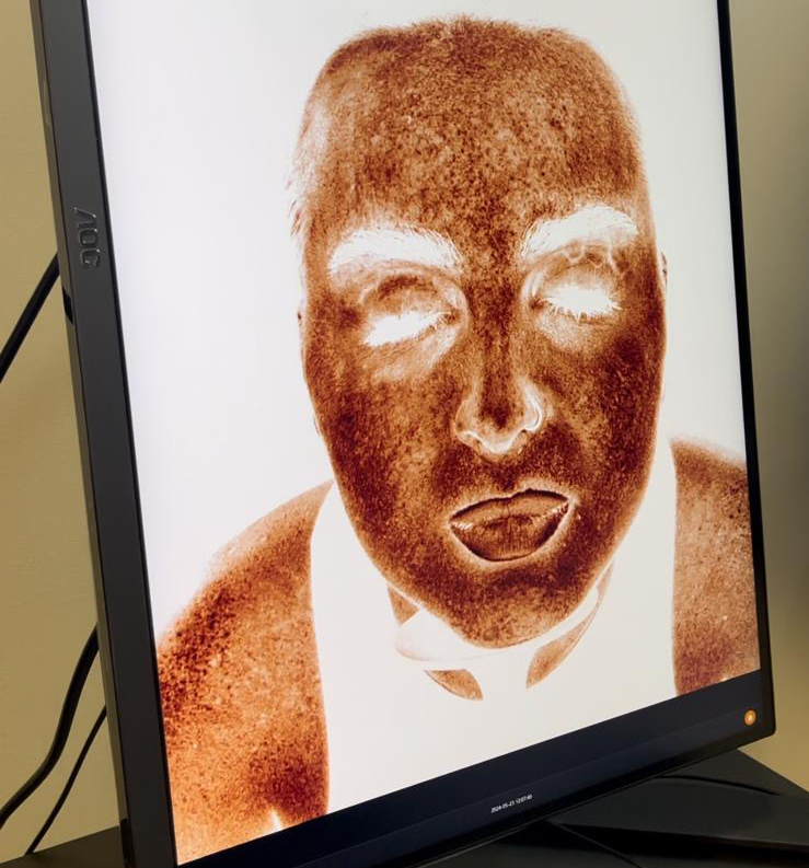 Skin pigmentation treatment Newcastle