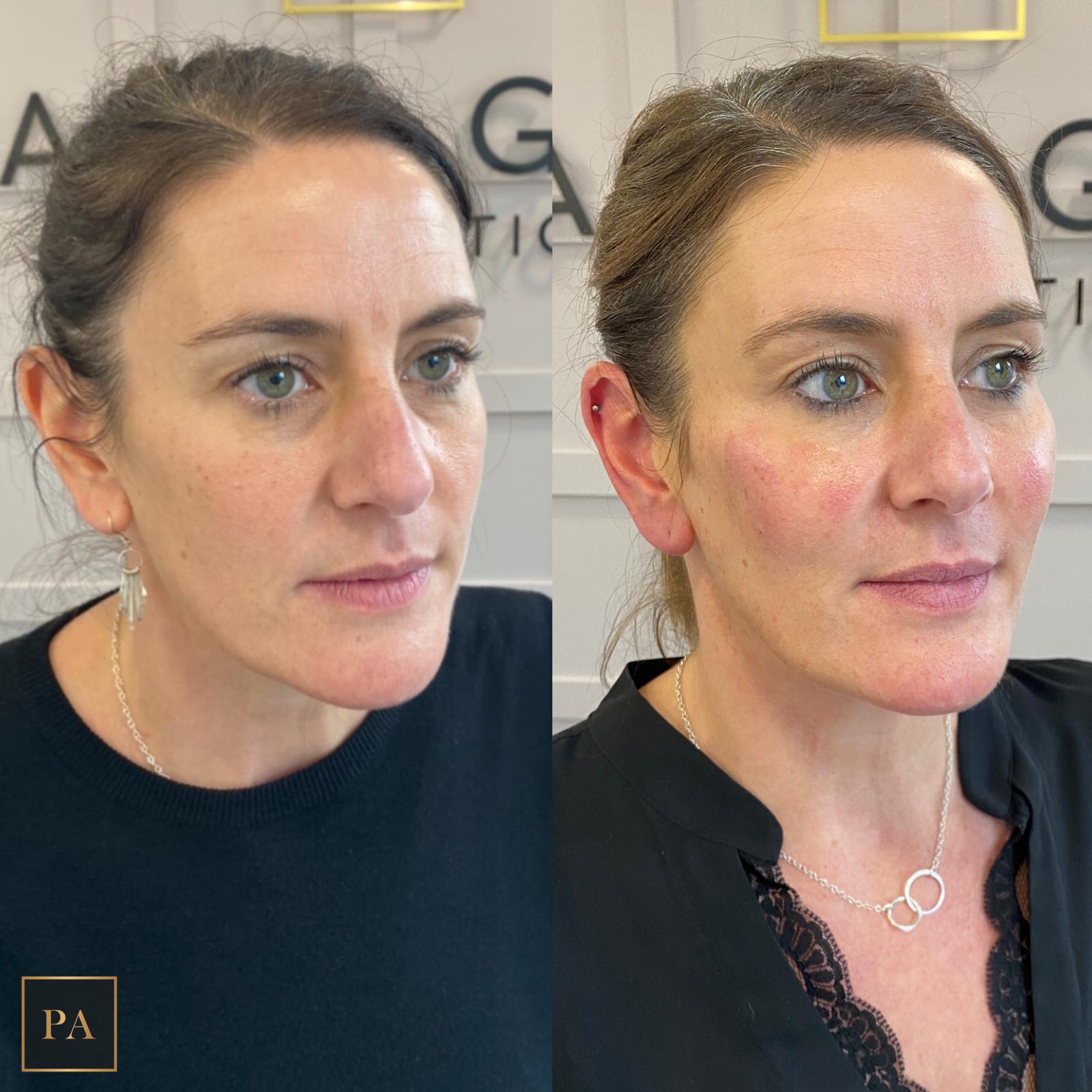 Dermal fillers for facial sagging in Newcastle