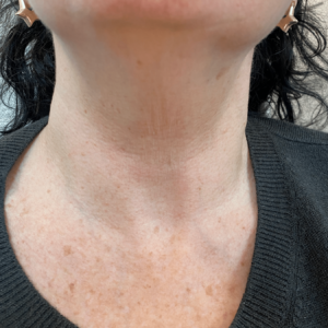 Before Radiesse wash treatment