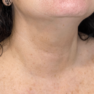 Neck after Radiesse wash treatment