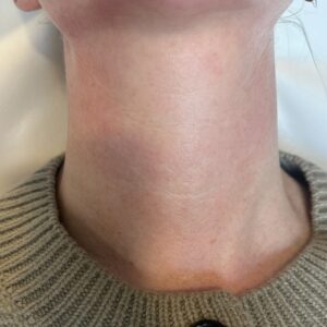 Radiesse wash treatment in Newcastle